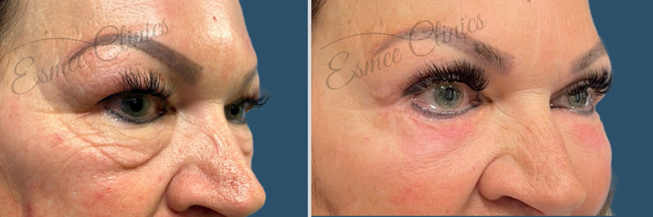 Before and After img